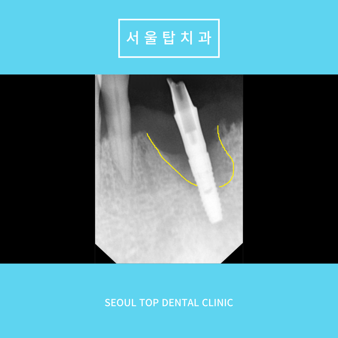 서울탑치과 임플란트