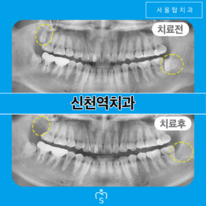 서울탑치과 사랑니발치