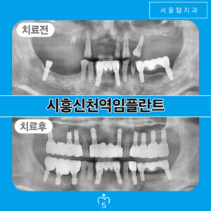서울탑치과 임플란트