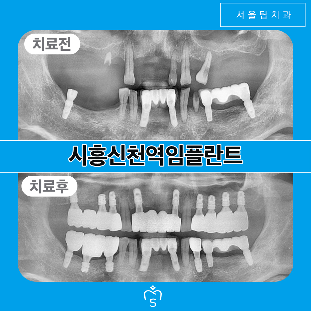 서울탑치과 임플란트