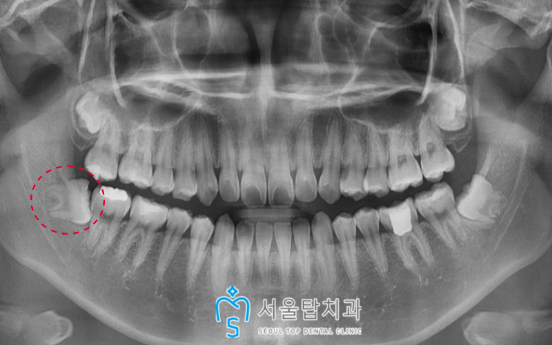 서울탑치과 사랑니발치