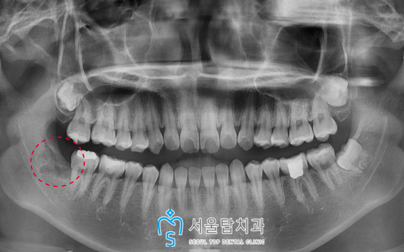 서울탑치과 사랑니발치