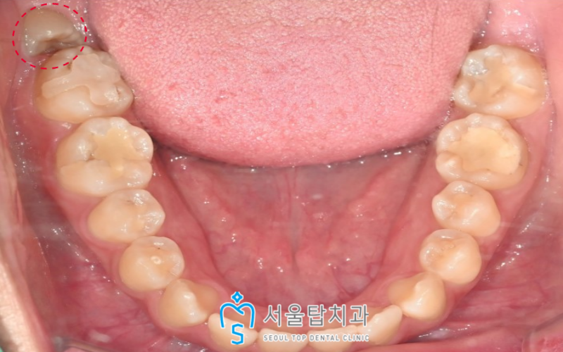 서울탑치과 사랑니발치