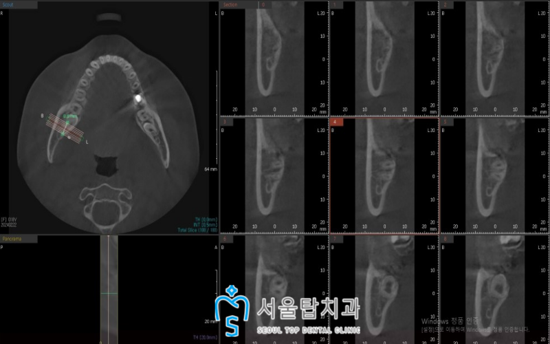 서울탑치과 사랑니발치