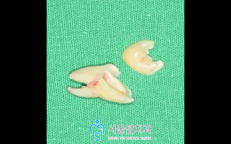 서울탑치과 사랑니발치