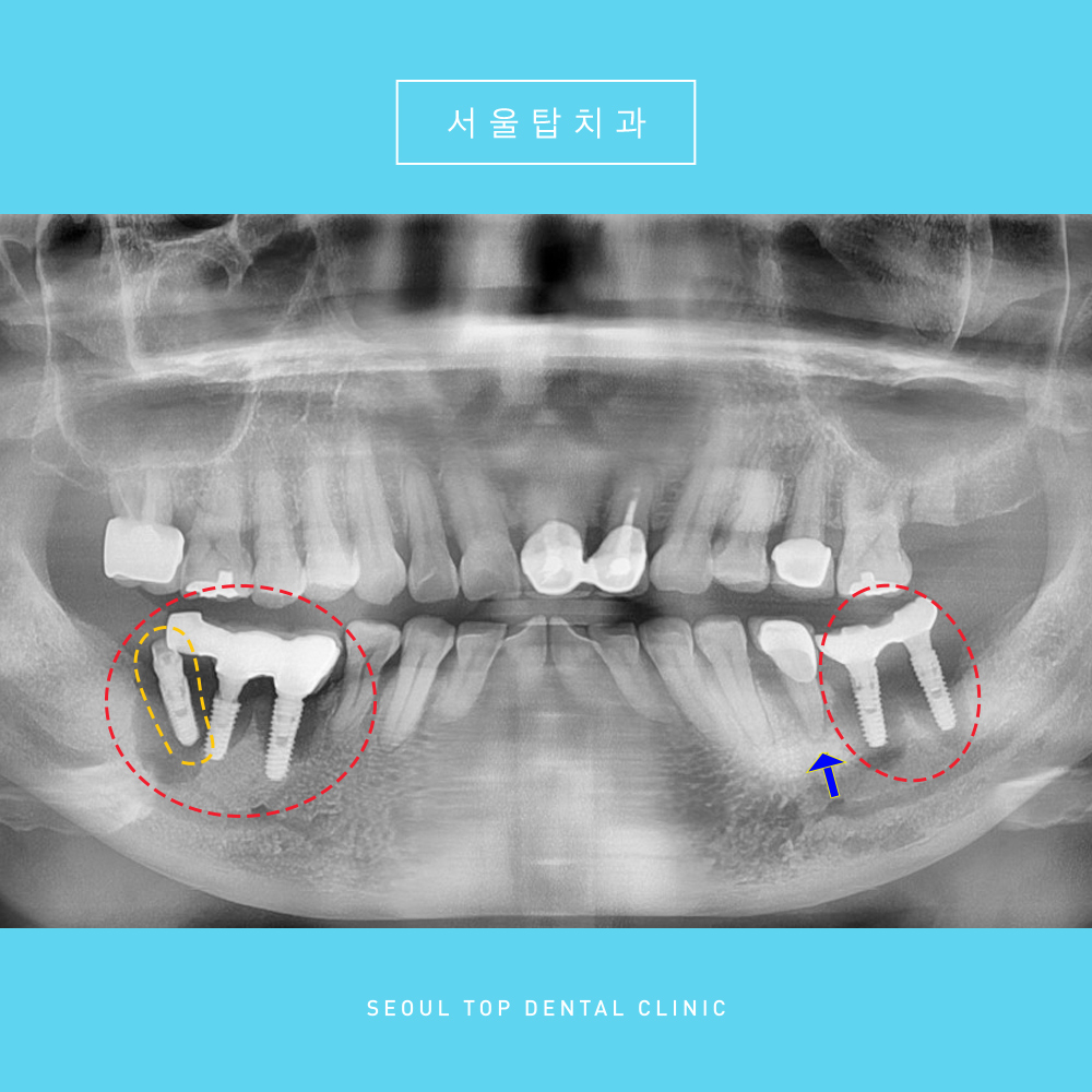 서울탑치과 임플란트