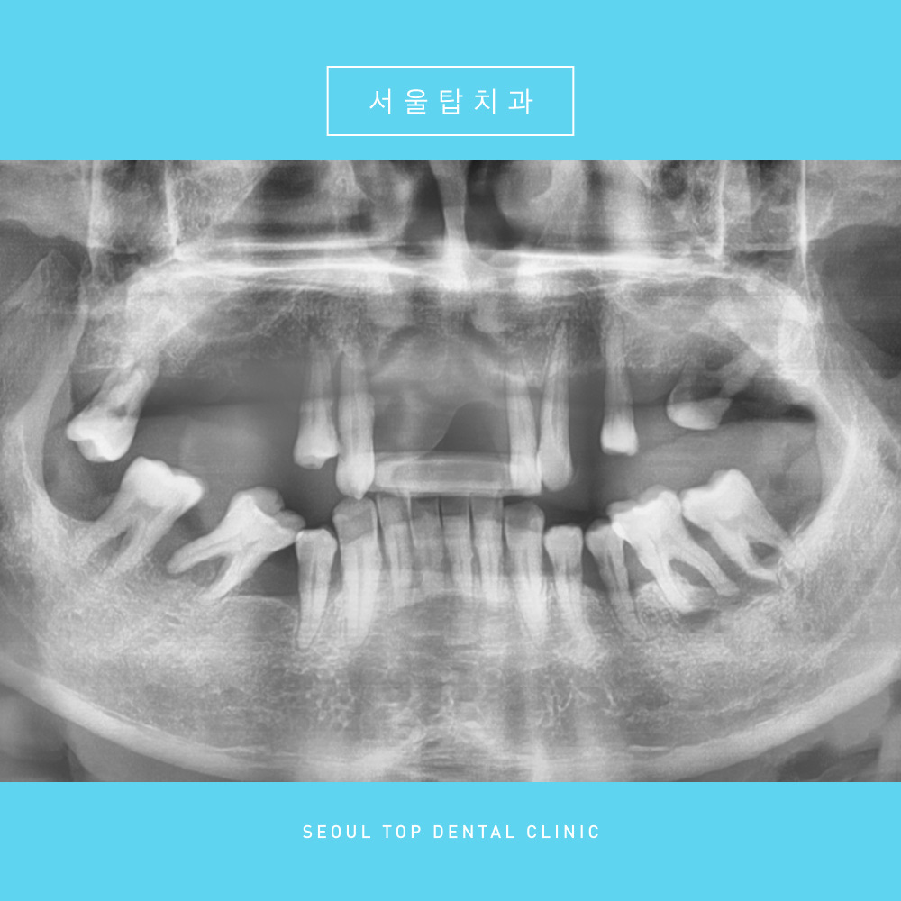 서울탑치과 임플란트