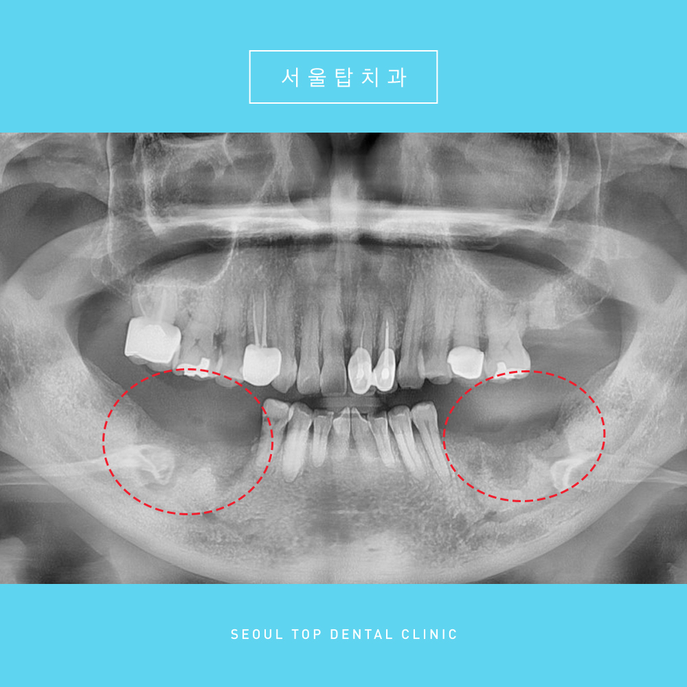 서울탑치과 임플란트