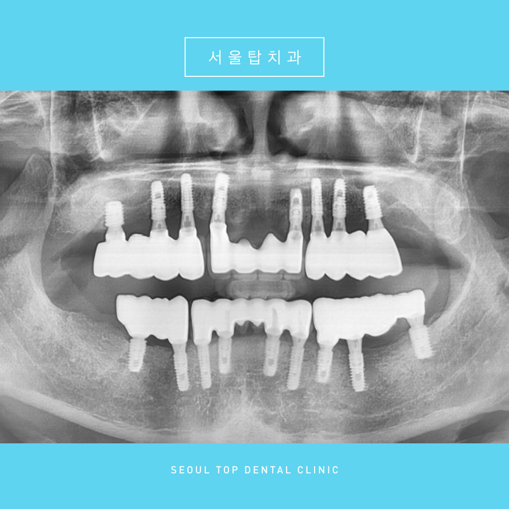 서울탑치과 임플란트