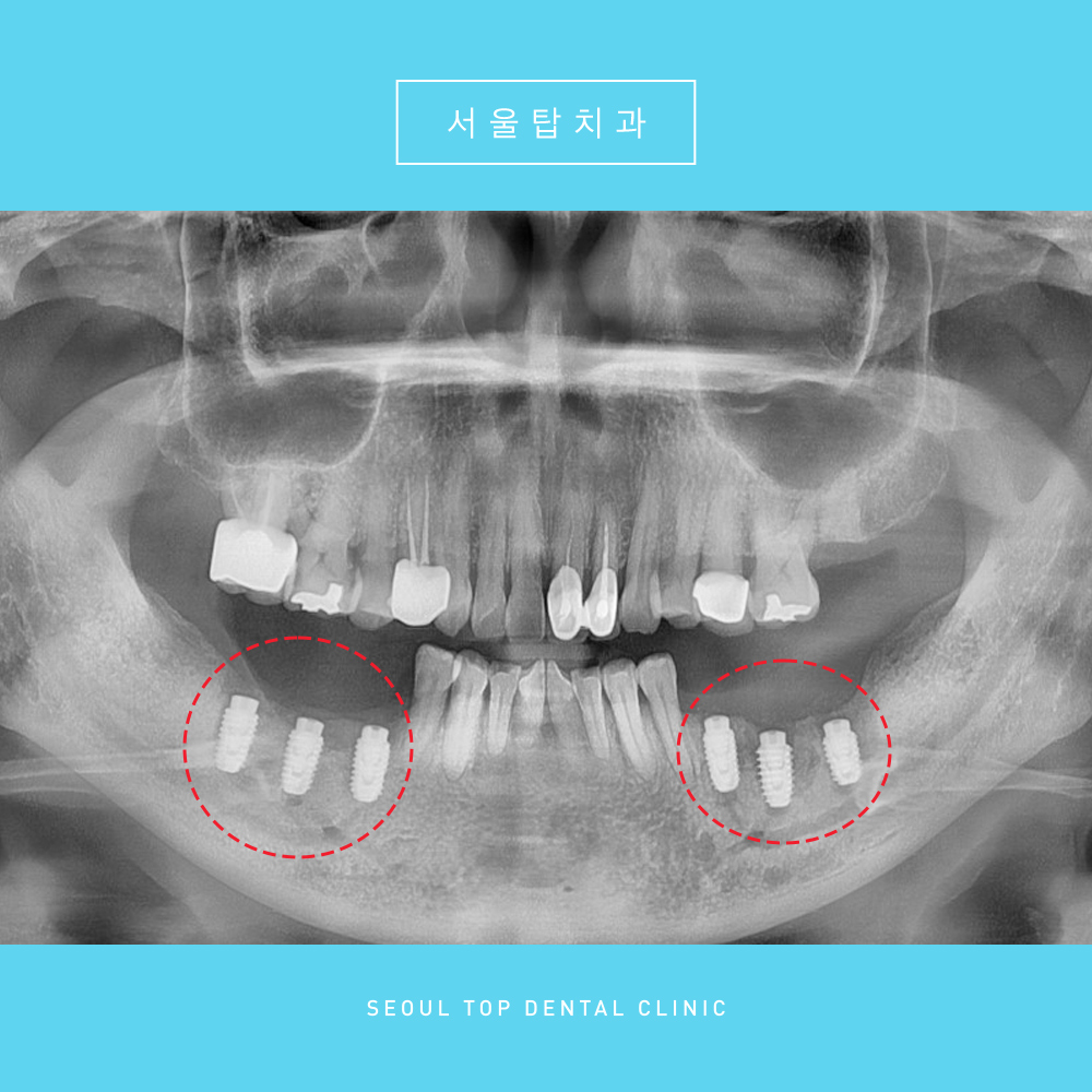 서울탑치과 임플란트