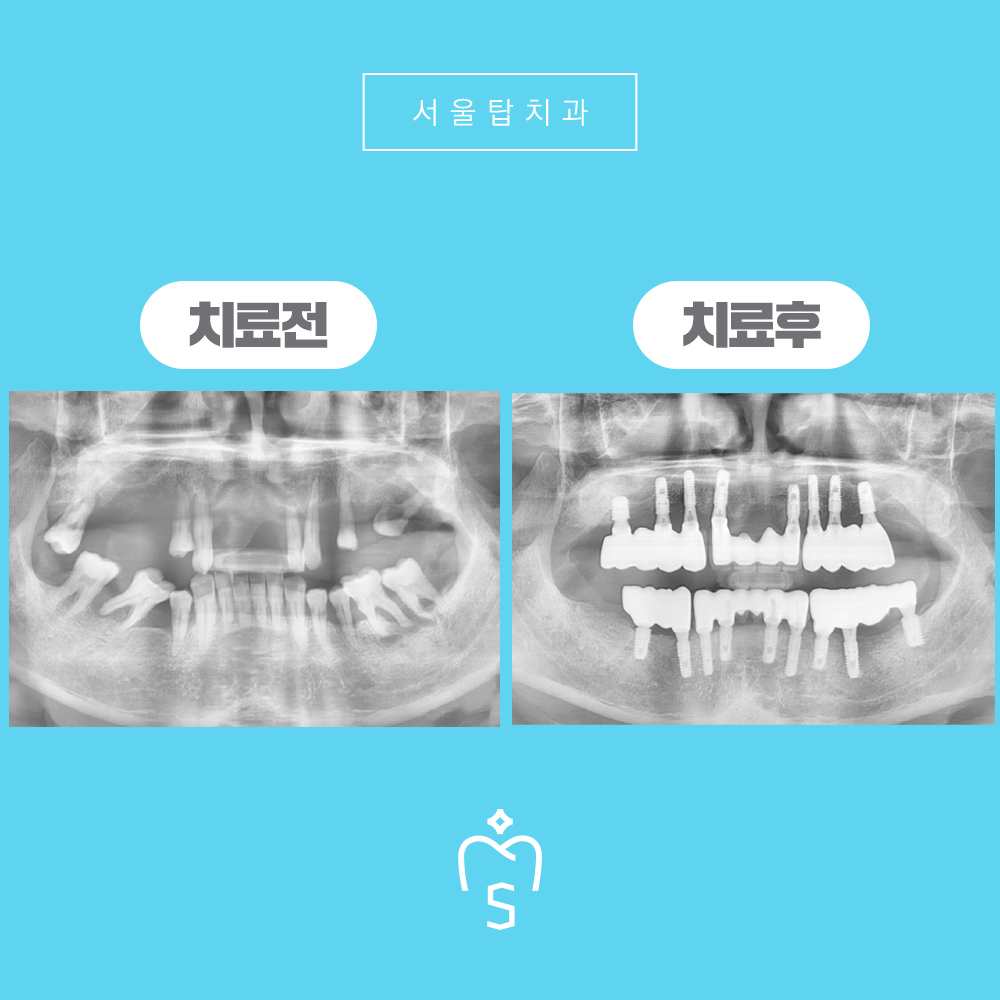 서울탑치과 임플란트