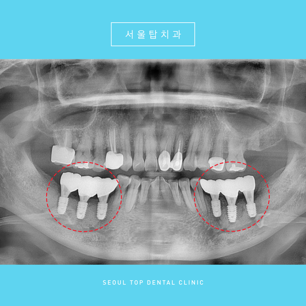 서울탑치과 임플란트