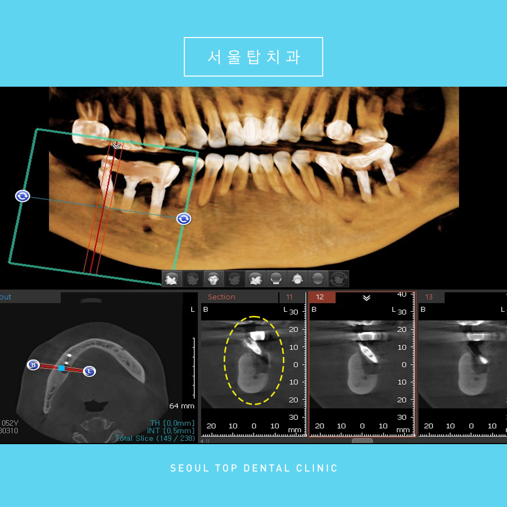 서울탑치과 임플란트