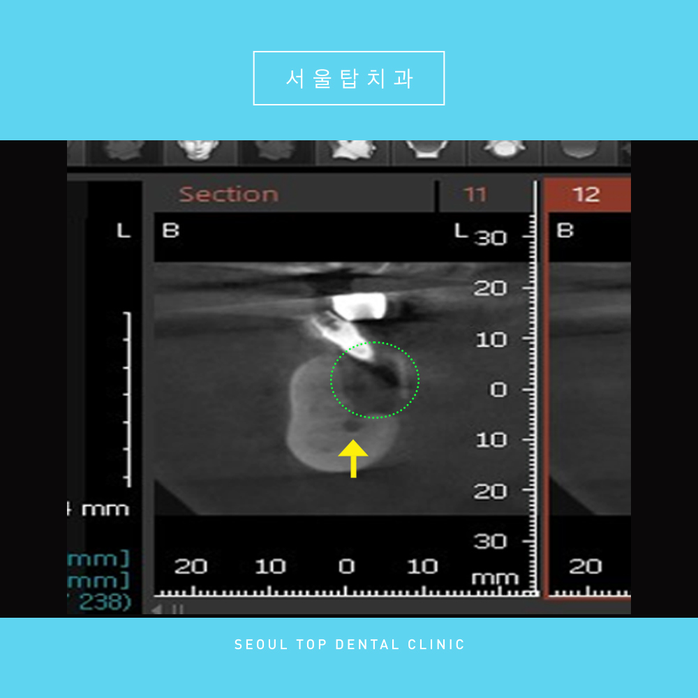 서울탑치과 임플란트