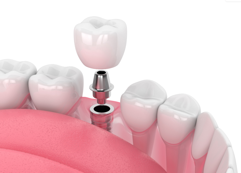 서울탑치과 임플란트