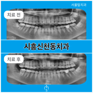 서울탑치과 사랑니발치