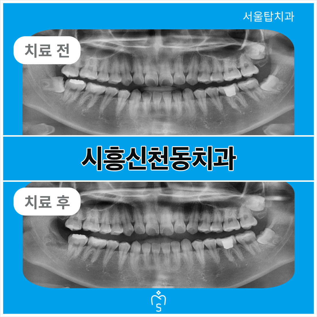 서울탑치과 사랑니발치