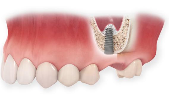서울탑치과 임플란트