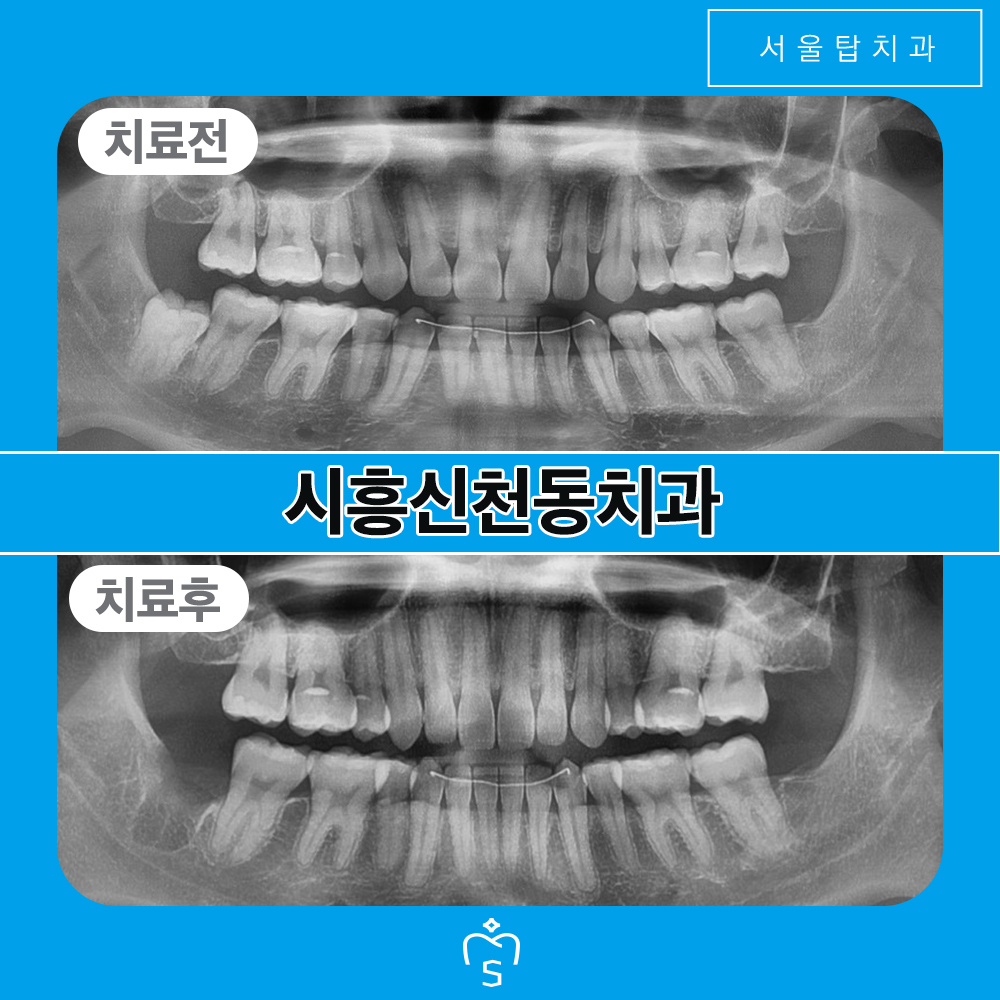 서울탑치과 사랑니발치