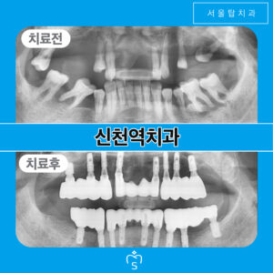 서울탑치과 임플란트