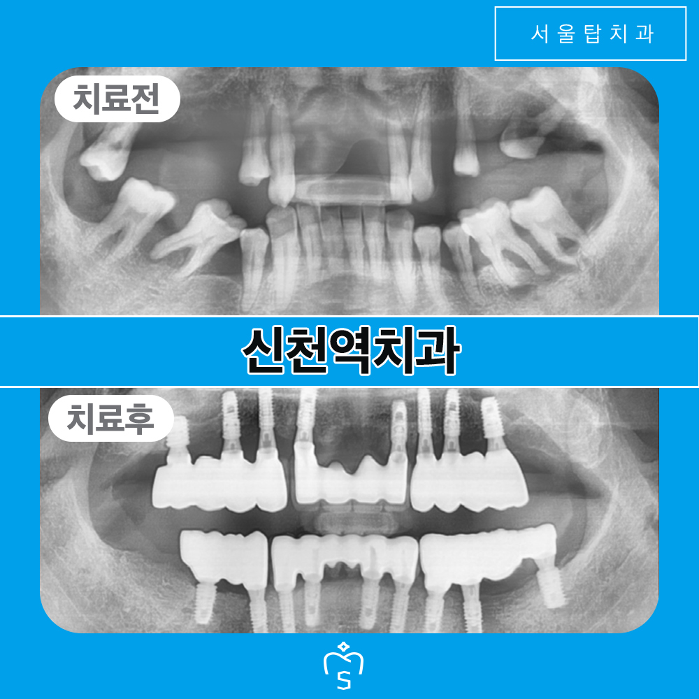 서울탑치과 임플란트