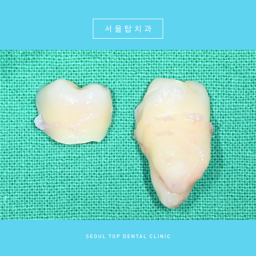 서울탑치과 사랑니발치