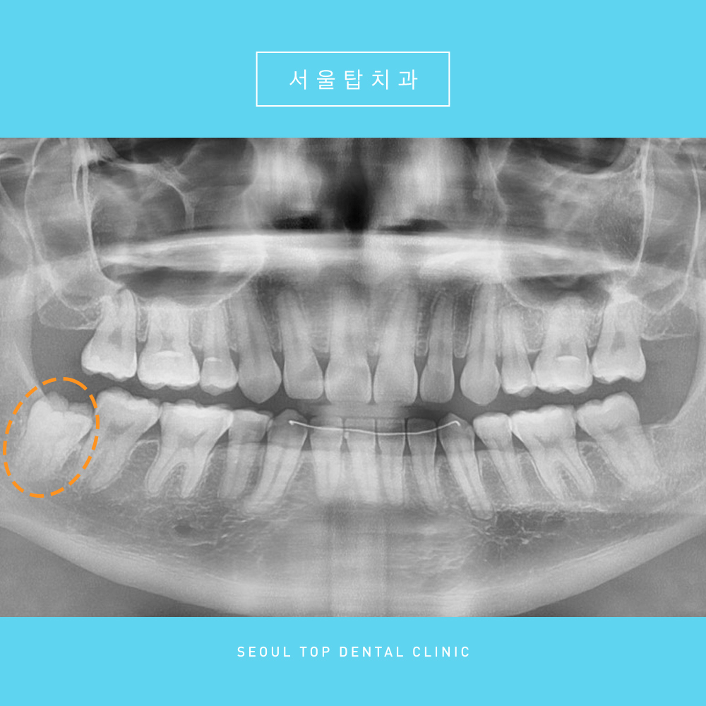 서울탑치과 사랑니발치