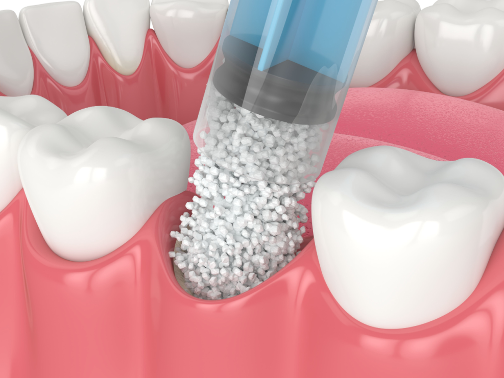 서울탑치과 임플란트