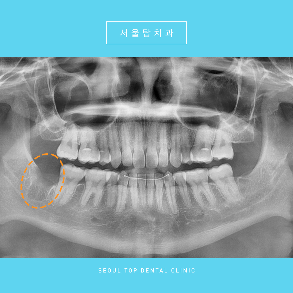 서울탑치과 사랑니발치
