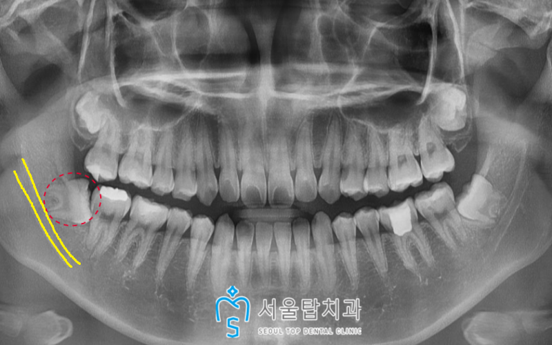 서울탑치과 사랑니발치