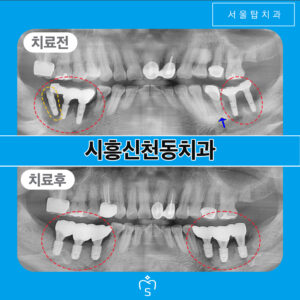 서울탑치과 임플란트