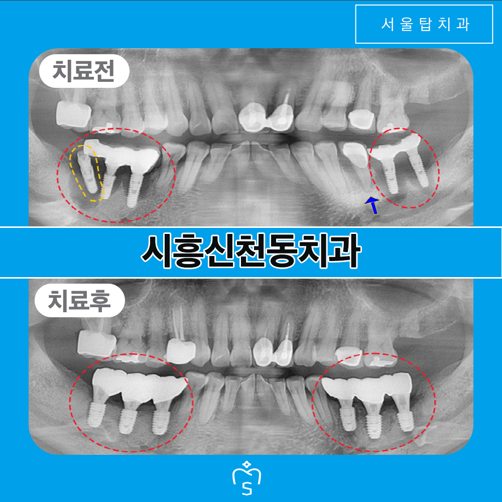 서울탑치과 임플란트