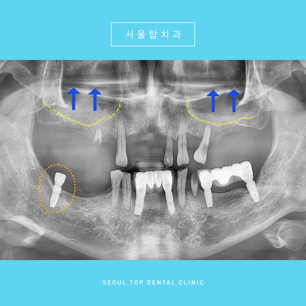 서울탑치과 임플란트