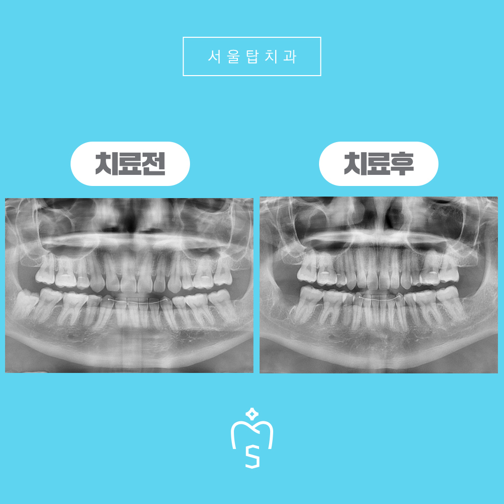 서울탑치과 사랑니발치