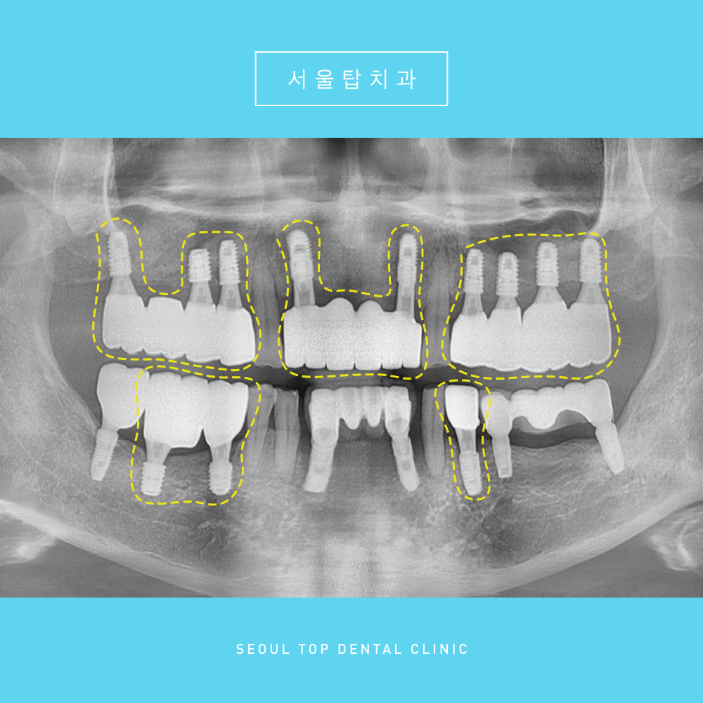 서울탑치과 임플란트