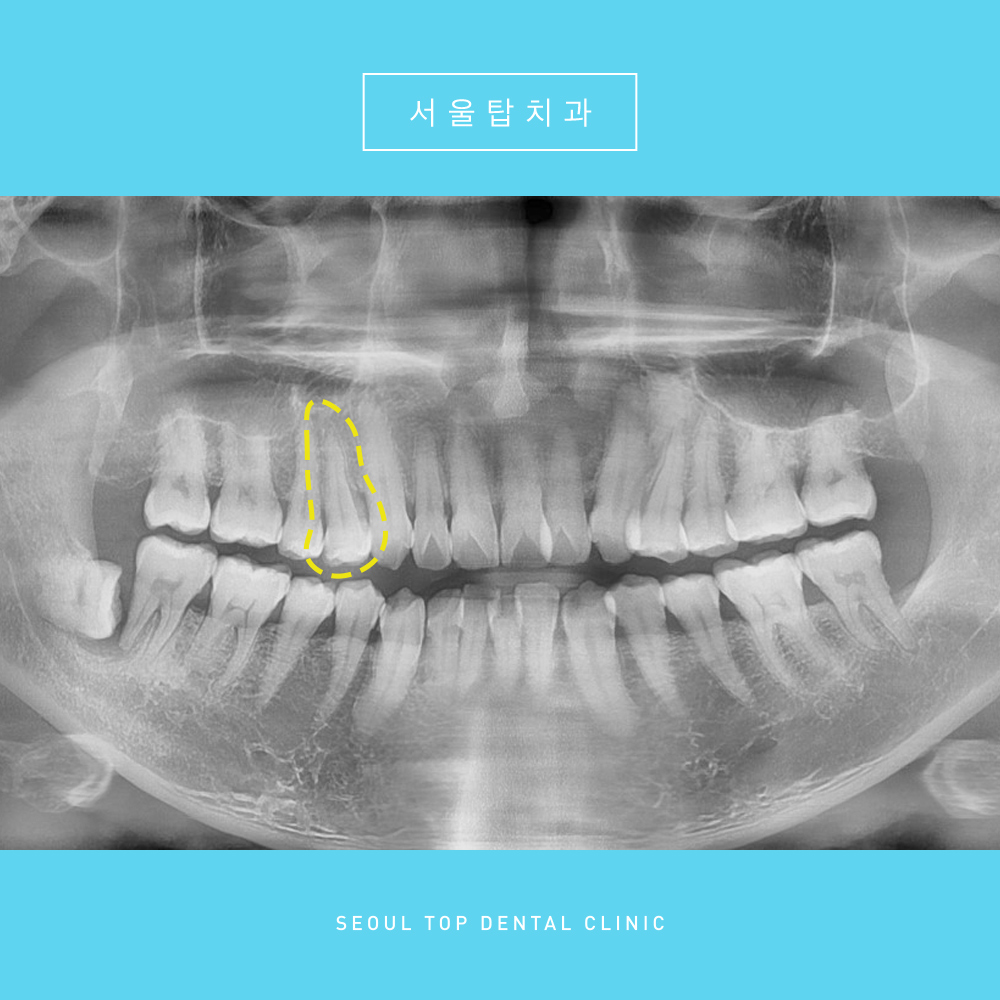 서울탑치과 충치치료