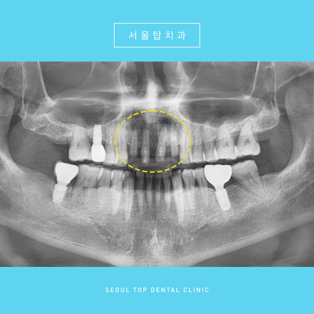 서울탑치과 임플란트