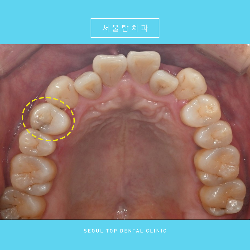 서울탑치과 충치치료