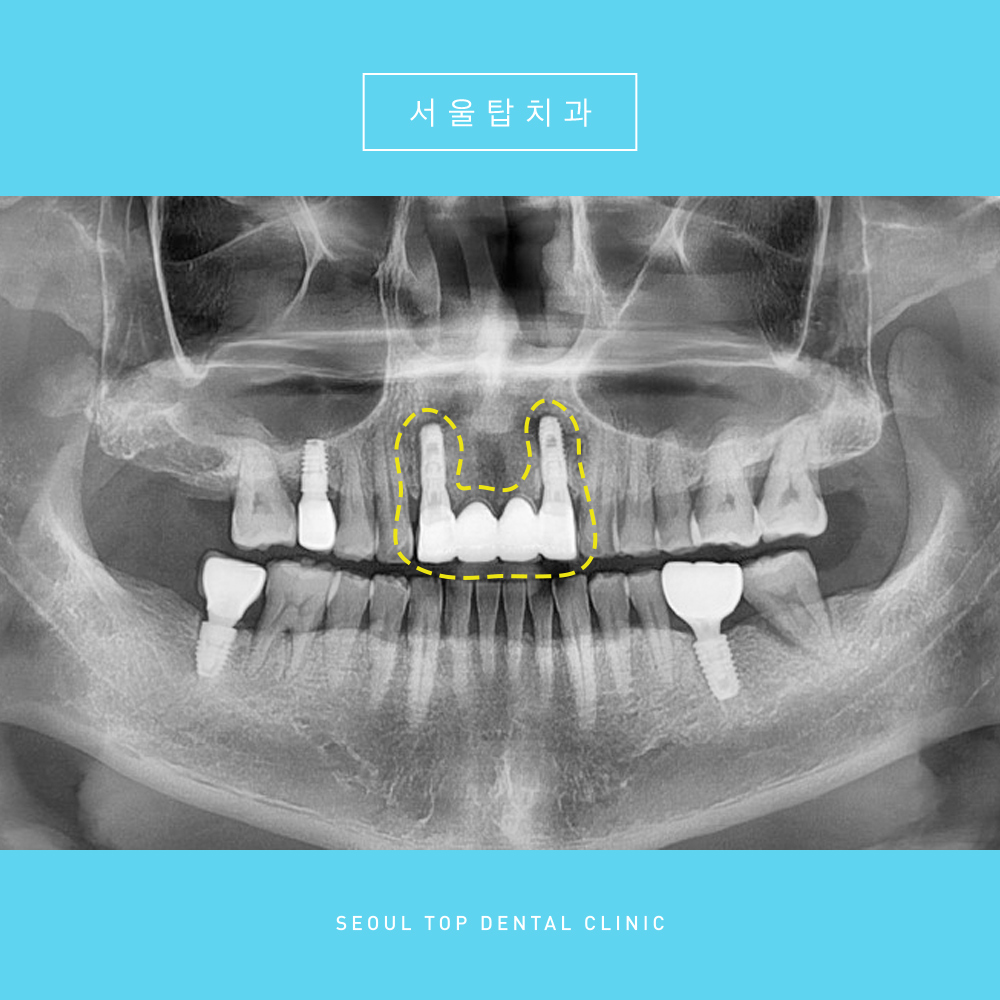 서울탑치과 임플란트