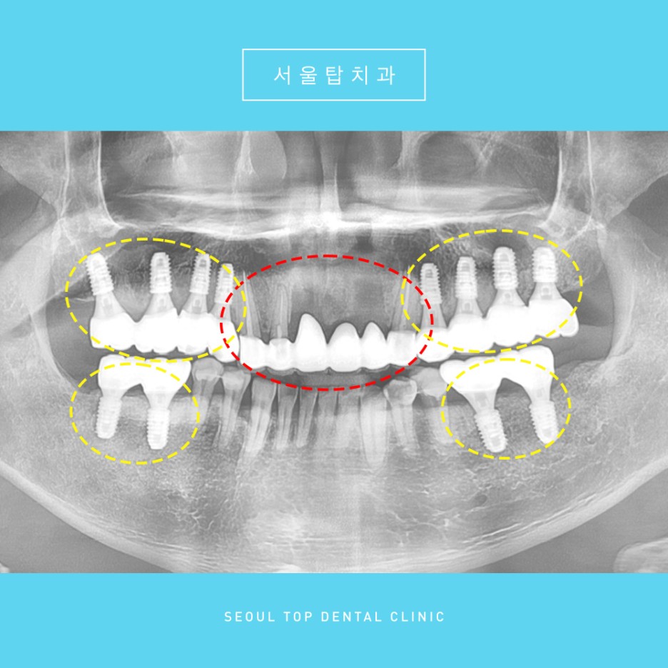 서울탑치과 임플란트