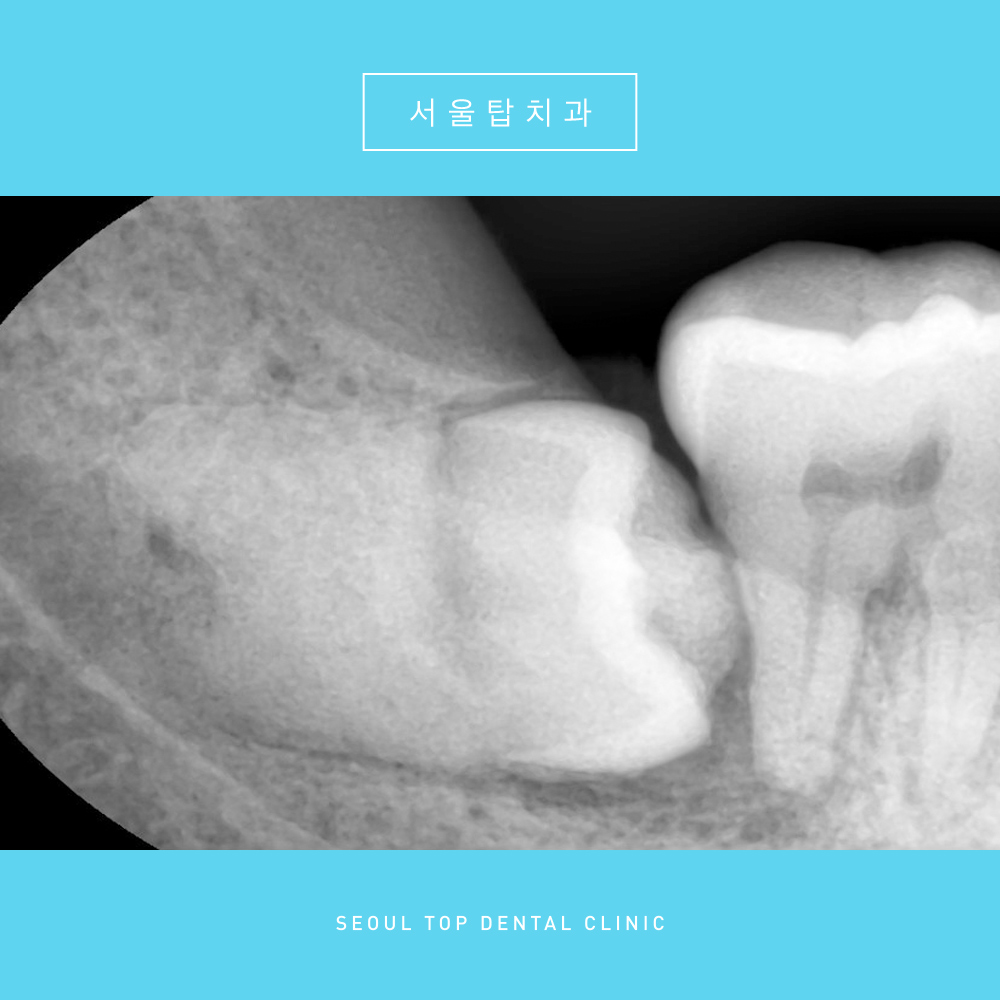 서울탑치과 사랑니발치