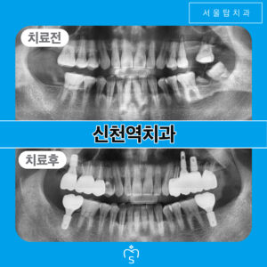 서울탑치과 임플란트