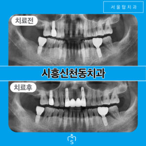 서울탑치과 임플란트