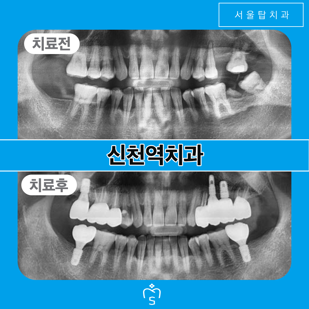 서울탑치과 임플란트
