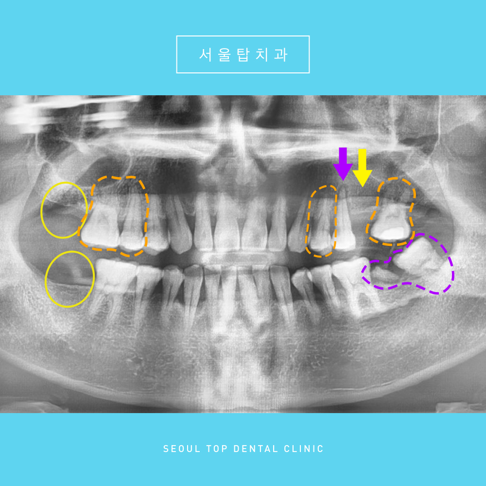 서울탑치과 임플란트