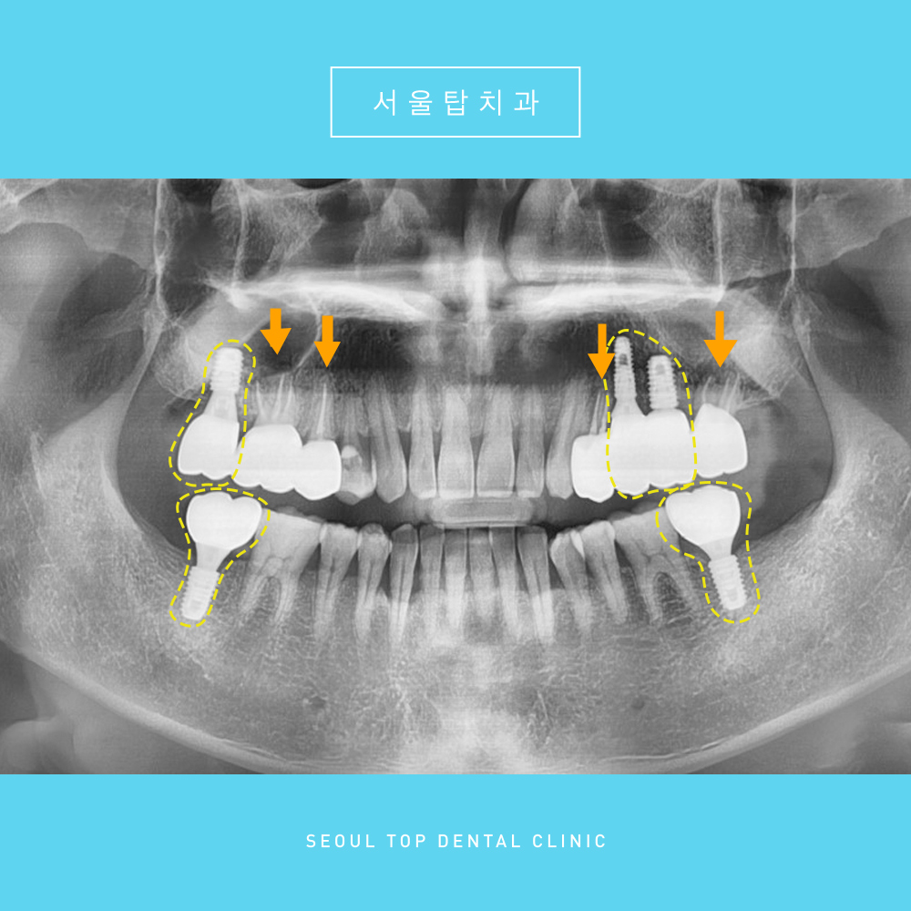 서울탑치과 임플란트