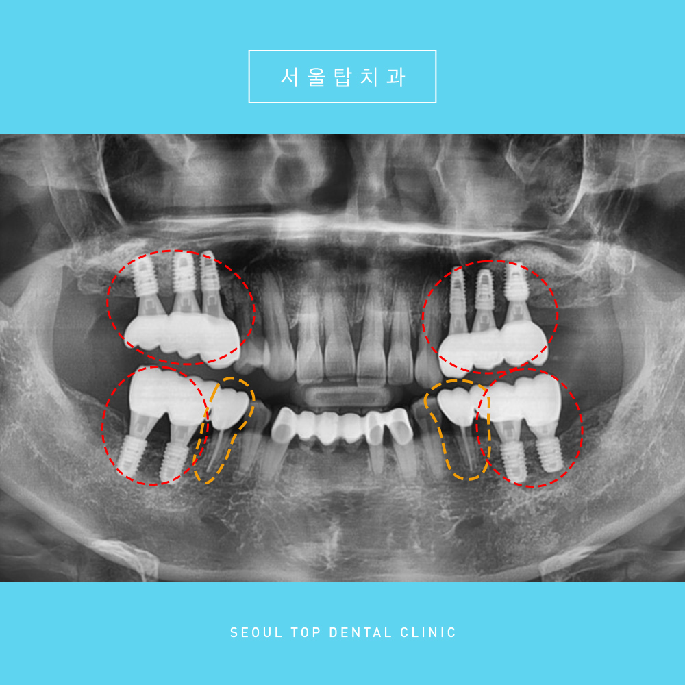 서울탑치과 임플란트