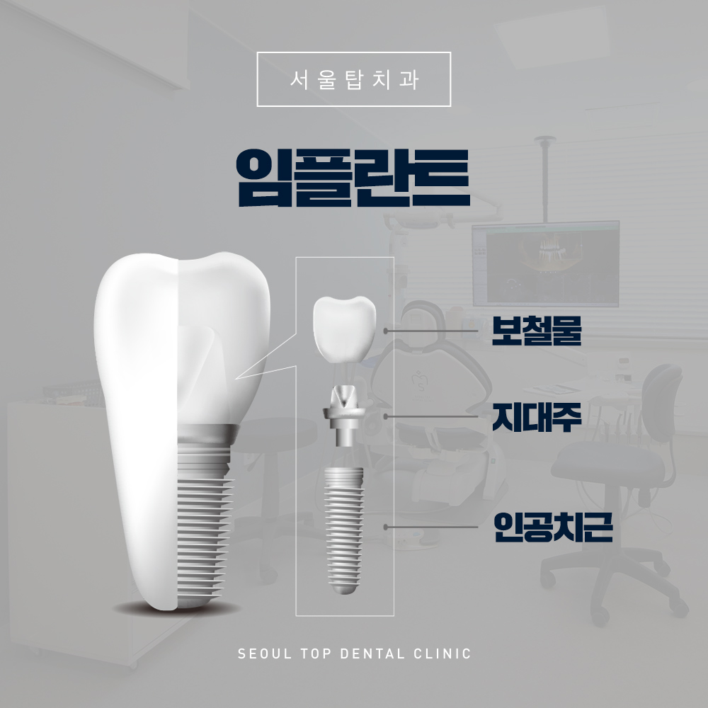 서울탑치과 임플란트