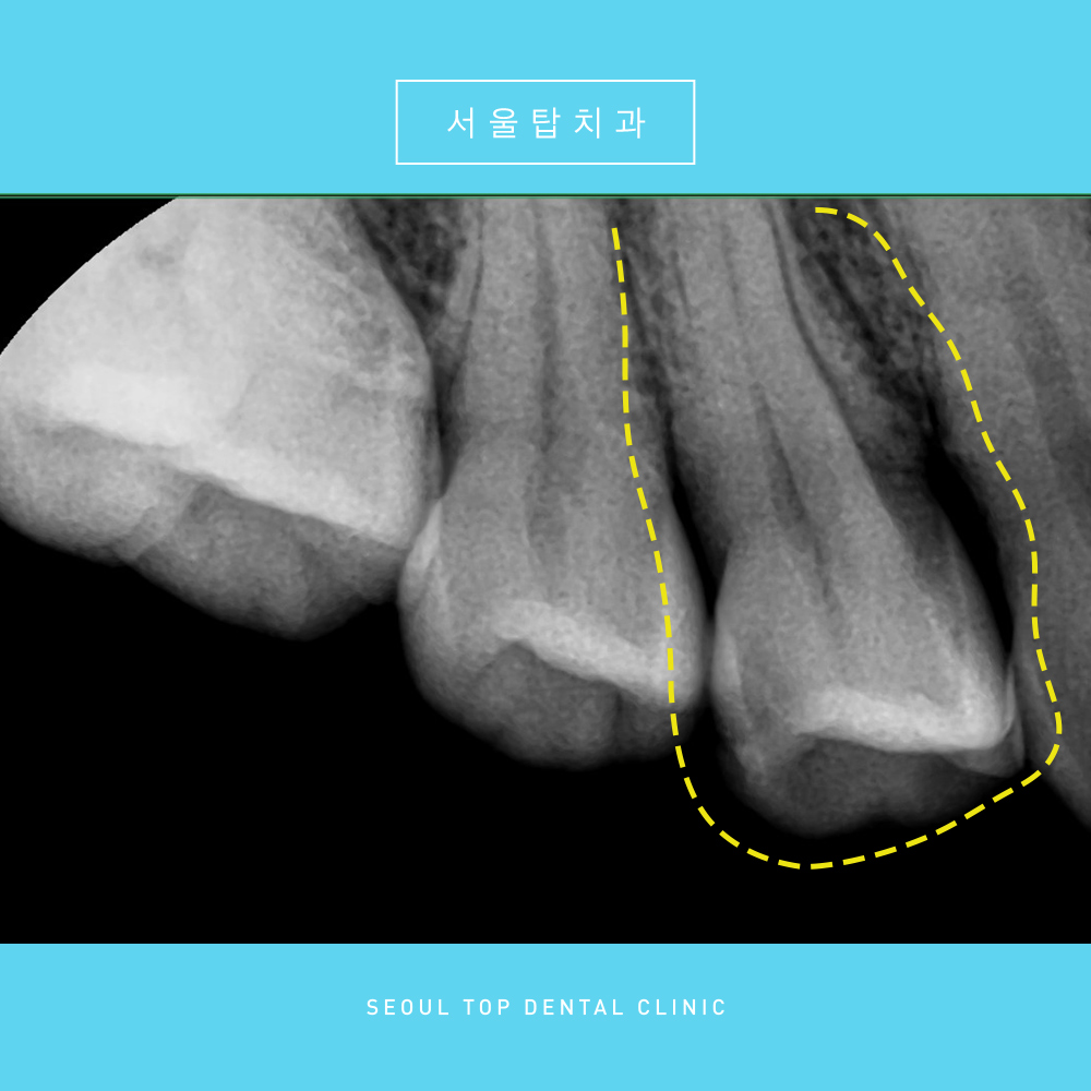 서울탑치과 충치치료