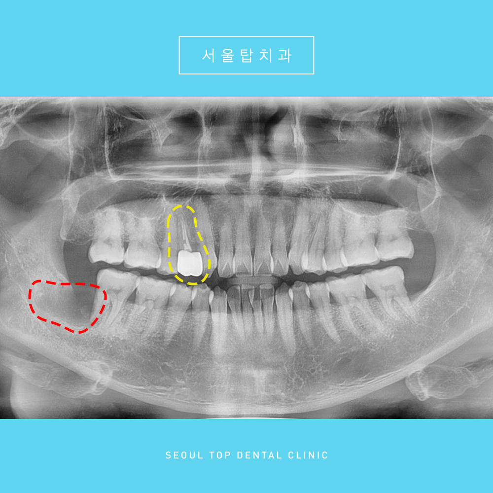 사랑니 발치 충치치료 후 사진